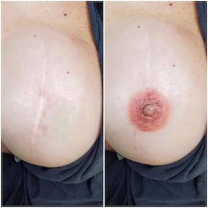 AREOLA 3D RECONSTRUCTION COURSE - 1 DAY